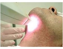 clínica de depilação a laser barba em Sumaré