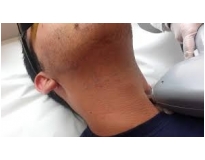 depilação a laser barbas em Sumaré