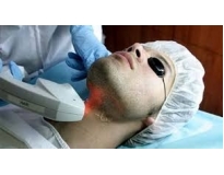 depilação a laser faciais em Cachoeirinha